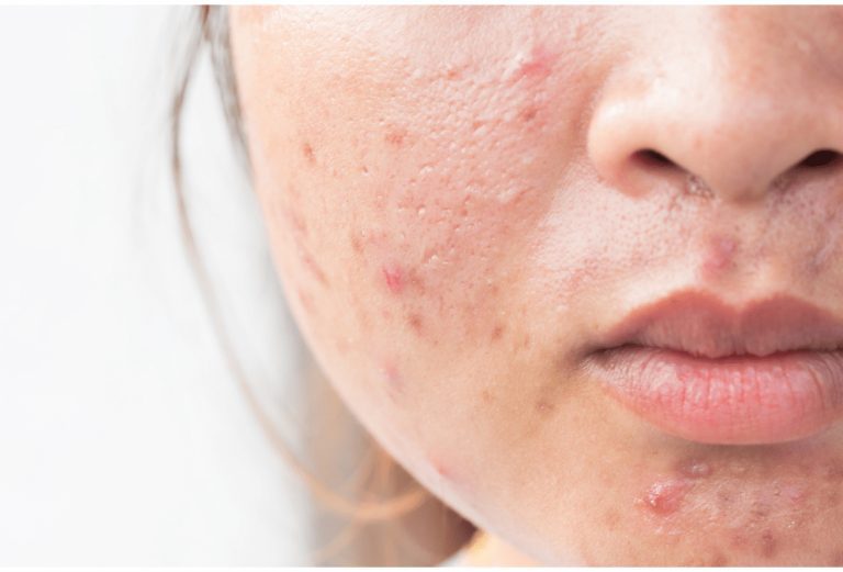 10 Surprising Causes of Acne Breakouts (and What to Do About It!)