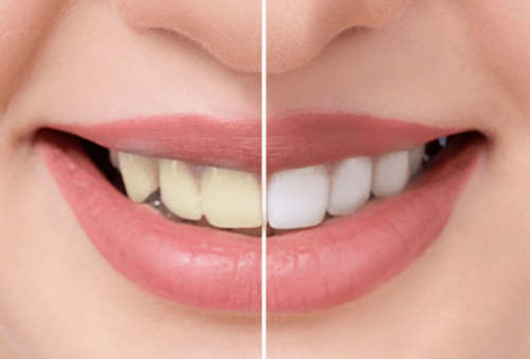 Here’s a Simple Method That is Helping People Get Whiter Teeth