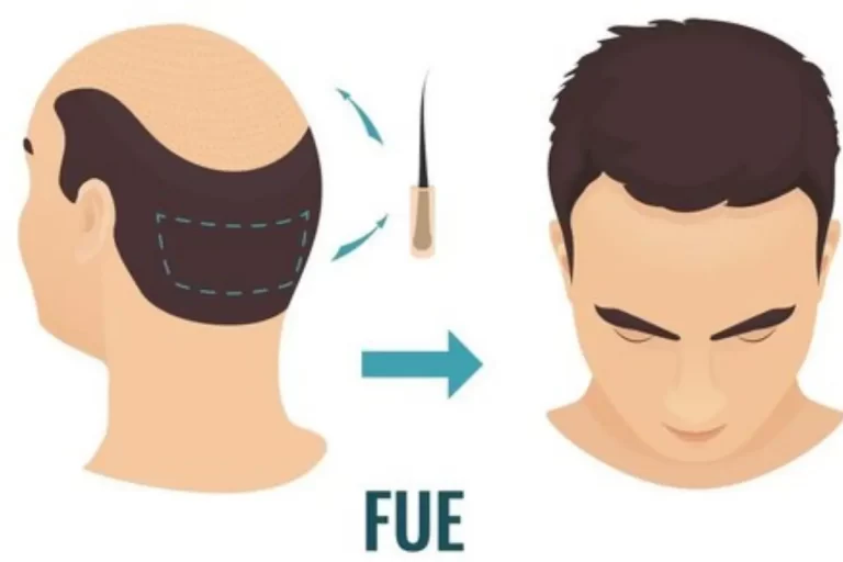 Hair Transplant Cost in Mysore at Reniu Clinic may surprise you!