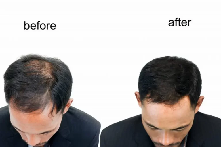 Before getting a hair transplant, you should know a few things.