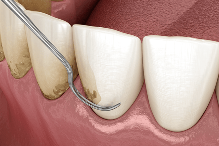 Exploring Cutting-Edge Periodontic Treatments for Gum Conditions