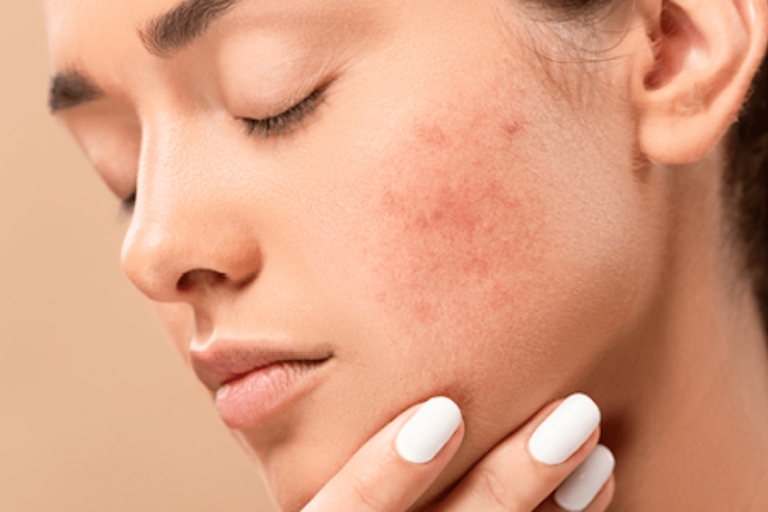 Acne: Navigating the Depths of Effective Treatment for Acne Prone Skin