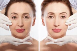 How to Prepare for Facelift Surgery
